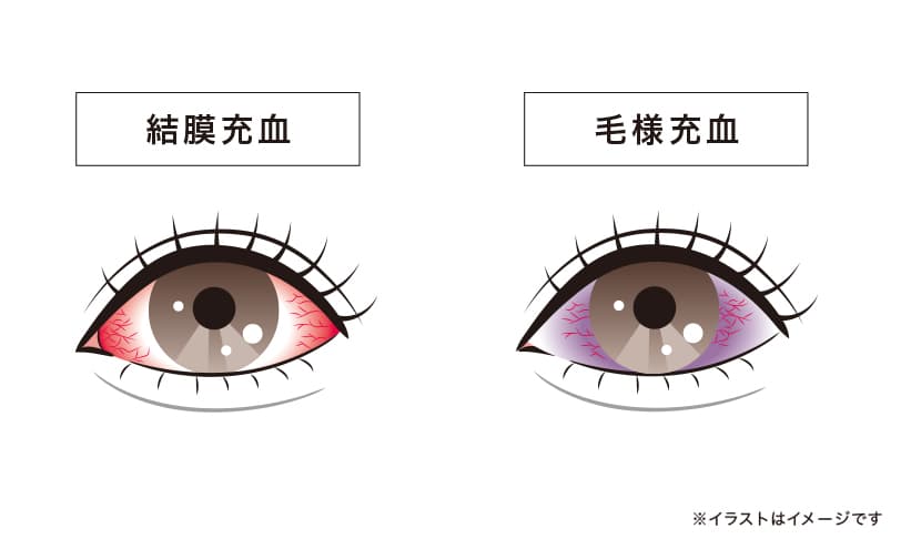 結膜充血と毛様充血
